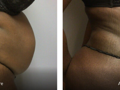33 year old female before and after tummy tuck and back liposuction