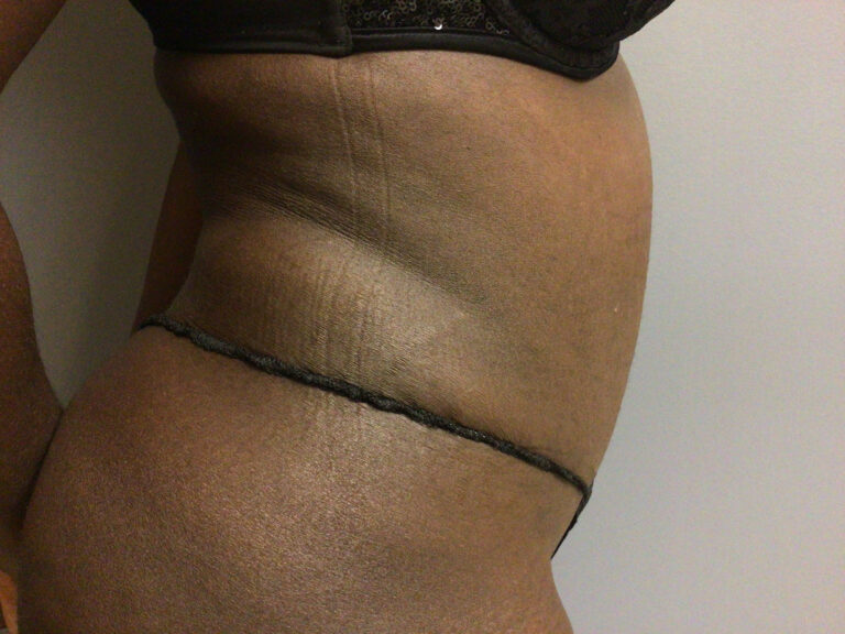 33 year old female right side side view 3 months post op