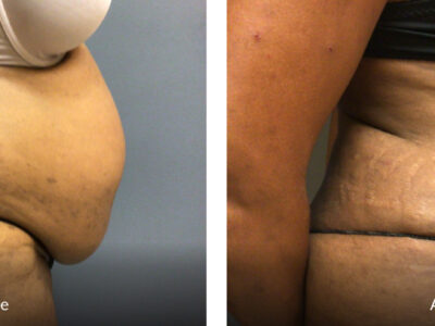 53 year old female 3 months before and after tummy tuck surgery