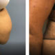 53 year old female 3 months before and after tummy tuck surgery