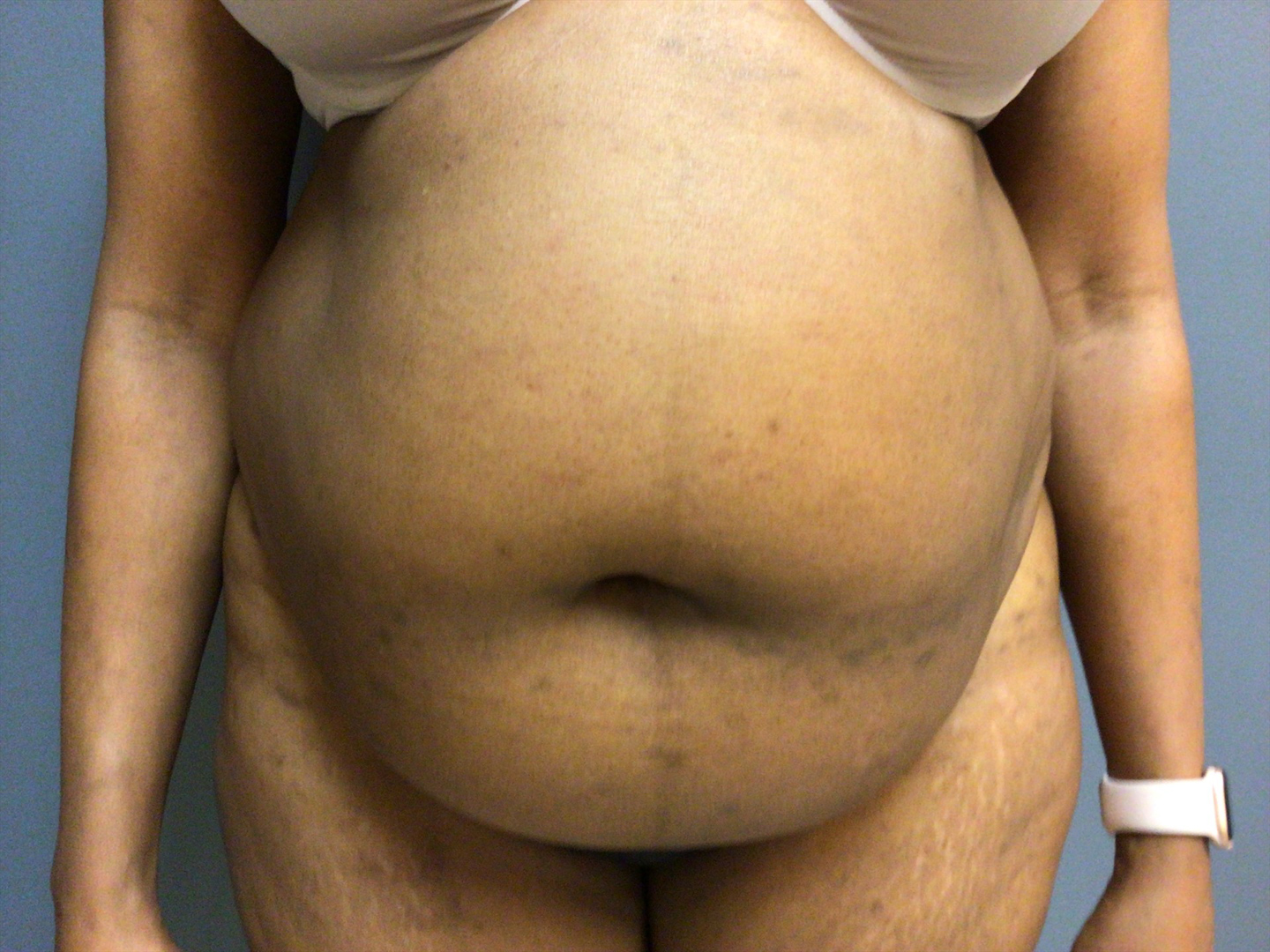 53 year old female before surgery
