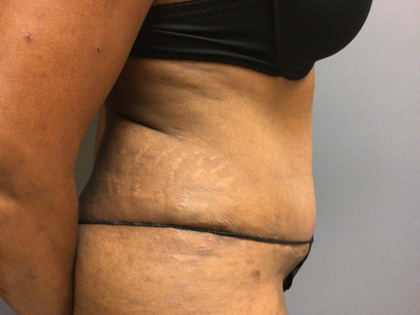 53 year old female right side 3 months post op tummy tuck