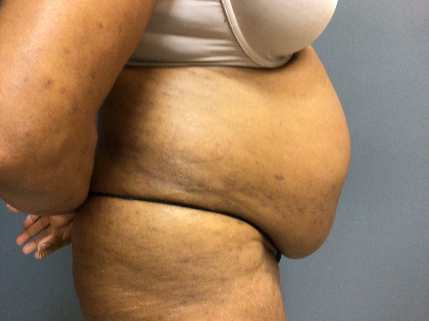 53 year old female right side before surgery