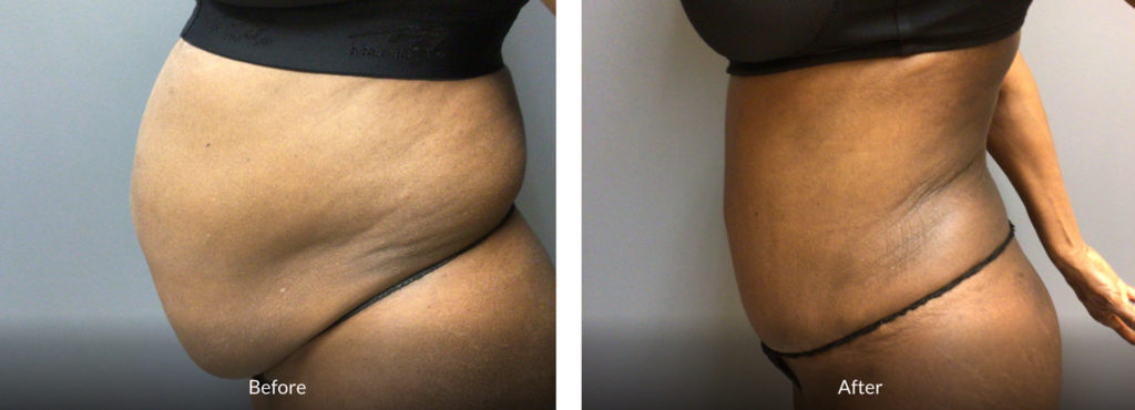 65 Year Old Before and After Tummy Tuck