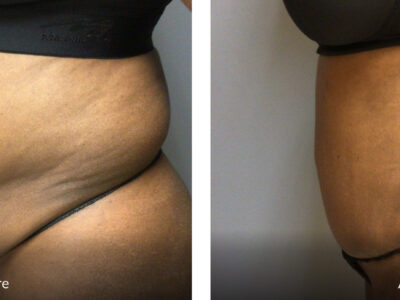65 Year Old Before and After Tummy Tuck