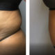 65 Year Old Before and After Tummy Tuck