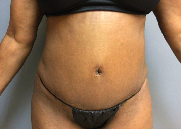 65 year old female 6 months post op