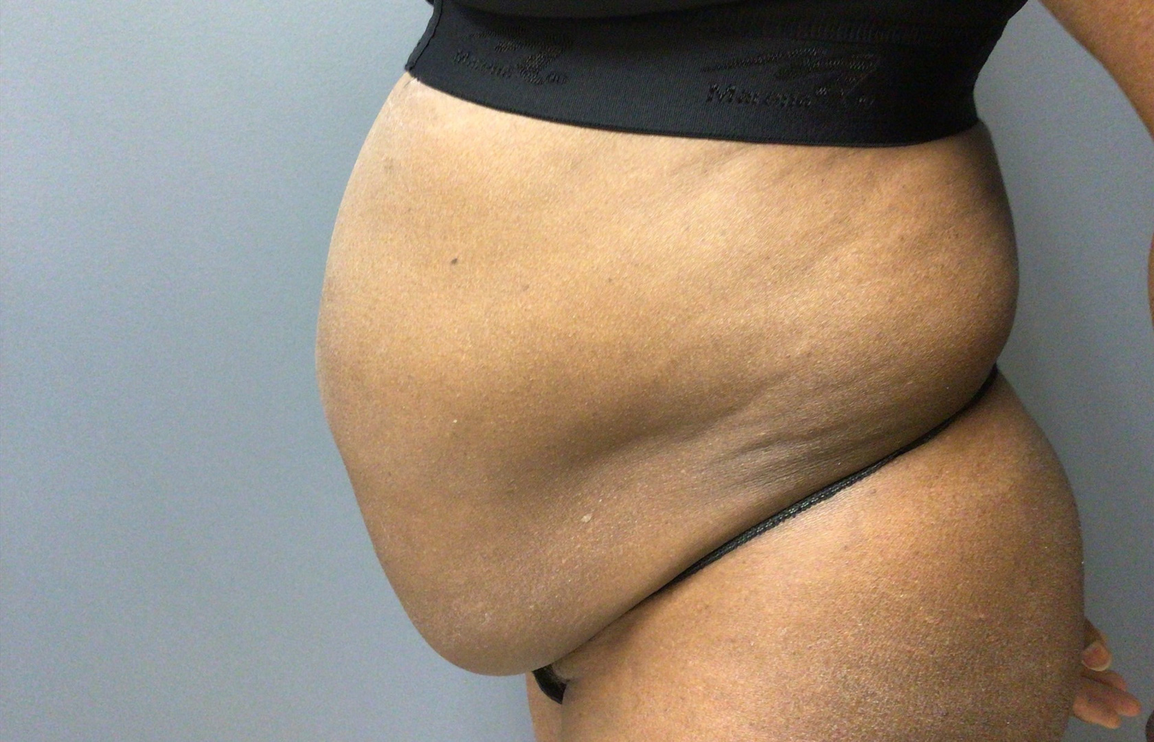 65 year old female left side view before surgery