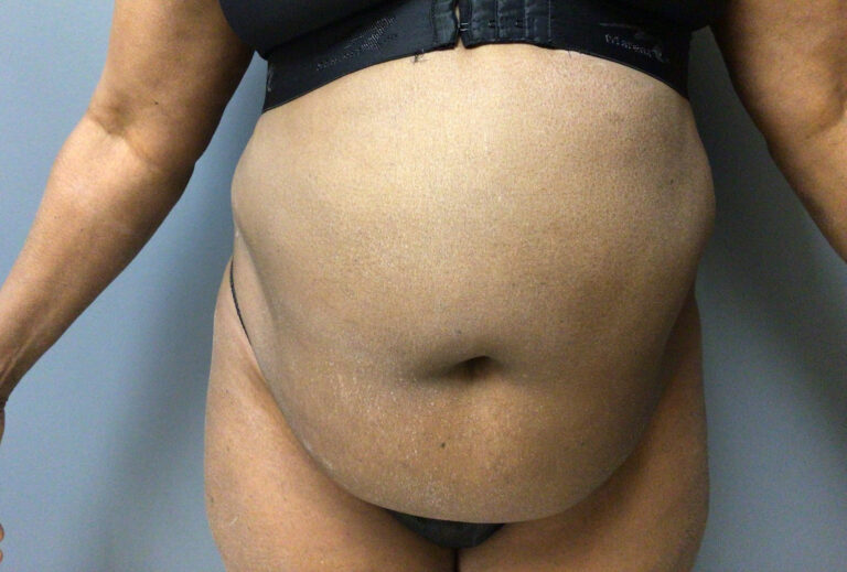 65 year old female preop