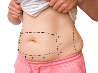 Plastic surgery doctor draw lines with marker on patient belly for tummy tuck