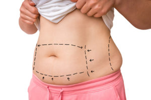 Plastic surgery doctor draw lines with marker on patient belly for tummy tuck