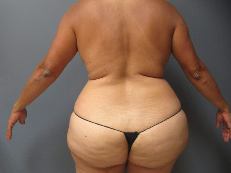 before tummy tuck and vaser liposuction