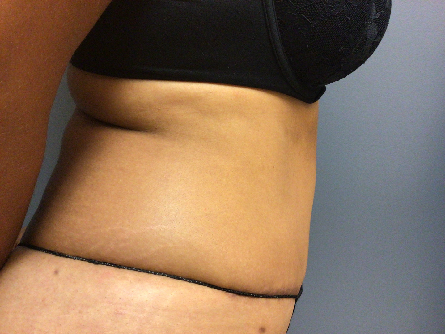after tummy tuck and vaser liposuction