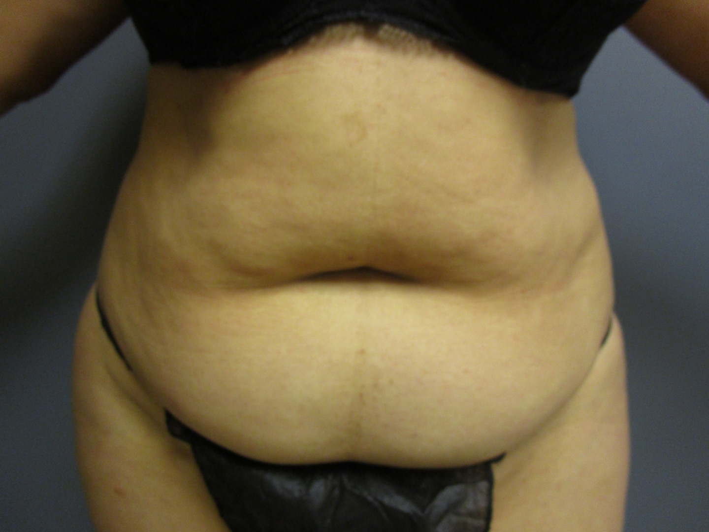 before tummy tuck and vaser liposuction