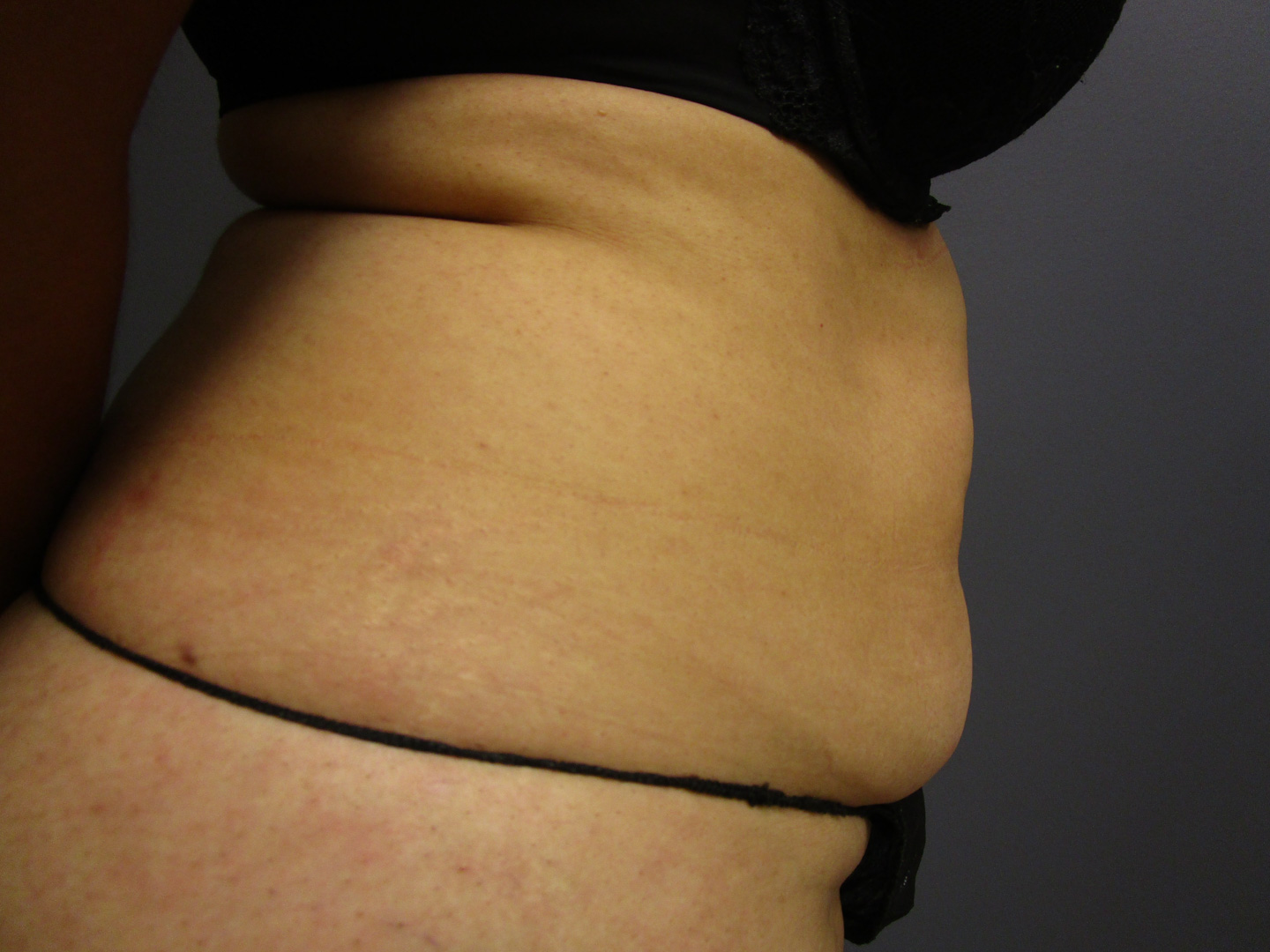 before tummy tuck and vaser liposuction