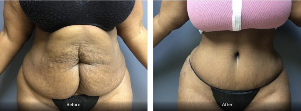 Before and After 58 Year Old tummy tuck abdominoplasty