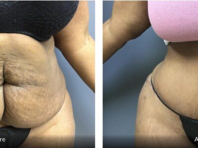 Before and After 58 Year Old tummy tuck abdominoplasty