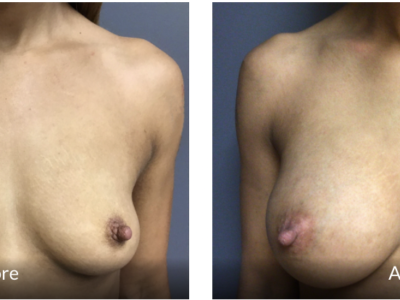 Before and After Breast Augmentation