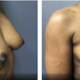49 year old Before and after inverted nipple repair