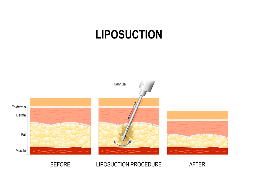 liposuction surgery graphic