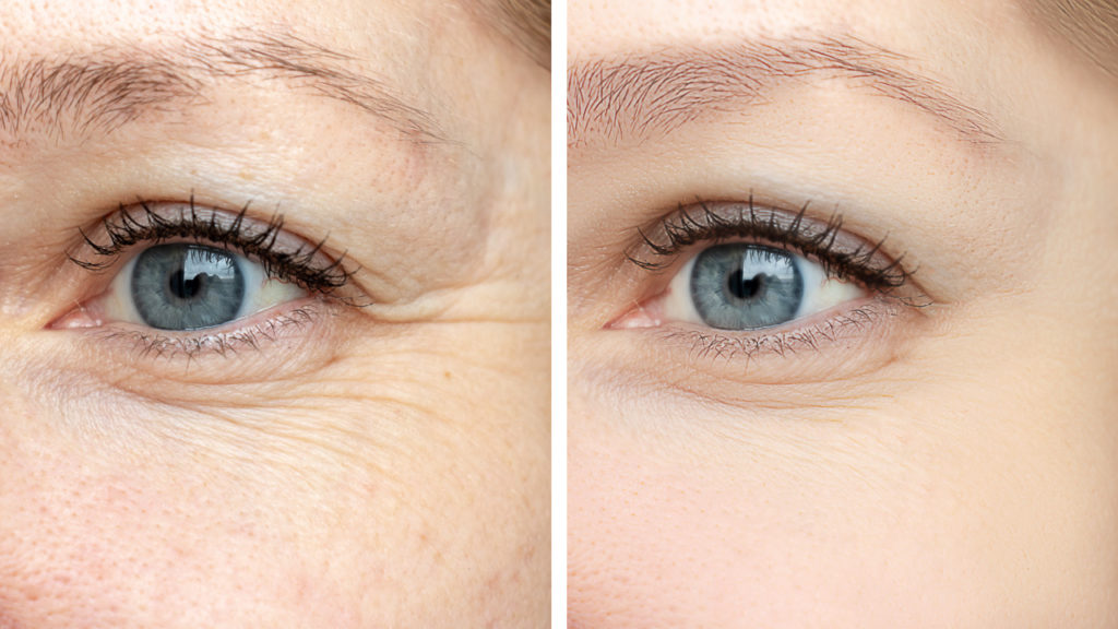 does botox prevent wrinkles? before and after photo