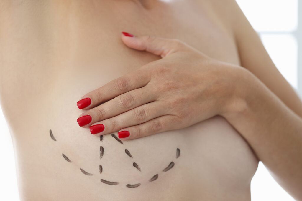 Doctor drew markers around breast in preparation for mammoplasty with surgical marker. Plastic surgery breast augmentation concept.