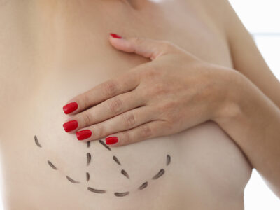 Doctor drew markers around breast in preparation for mammoplasty with surgical marker. Plastic surgery breast augmentation concept.