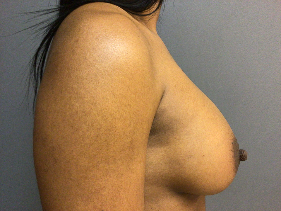 37-year-old female presented for breast augmentation.  She desired more fullness in her breast.  She underwent bilateral breast augmentation with 375cc Mentor HP implants.  She is 5’5” tall and 160 lbs.  B cup preop, D cup post op.  She was very happy with her results.