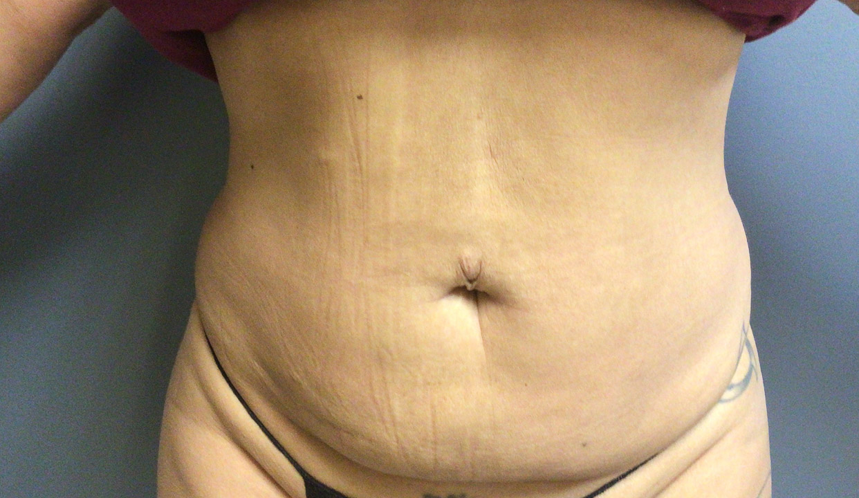 44 year old female 3 monts post op lipo 360 and BBL
