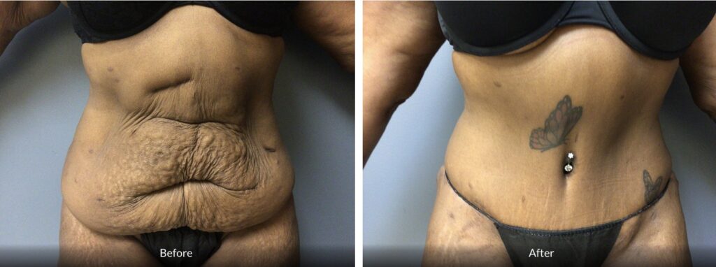 52 year old tummy tuck before and after