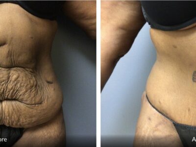 52 year old tummy tuck before and after