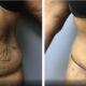 52 year old tummy tuck before and after