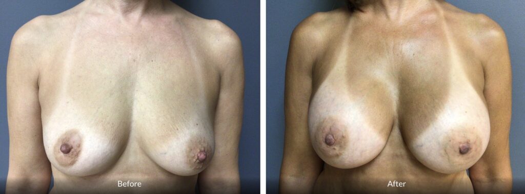 53-year-old female presented for bilateral breast augmentation.  She want fuller breast.  She underwent bilateral breast augmentation with Mentor HPX 415 cc.  Patient is 5’5”, 127 lbs.  A cup preop, D cup post op.  She was very happy with her results.