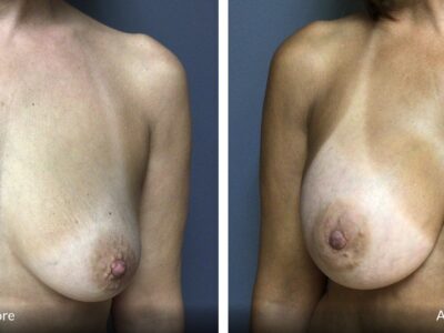 53-year-old female presented for bilateral breast augmentation.  She want fuller breast.  She underwent bilateral breast augmentation with Mentor HPX 415 cc.  Patient is 5’5”, 127 lbs.  A cup preop, D cup post op.  She was very happy with her results.