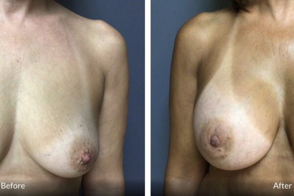 53-year-old female presented for bilateral breast augmentation.  She want fuller breast.  She underwent bilateral breast augmentation with Mentor HPX 415 cc.  Patient is 5’5”, 127 lbs.  A cup preop, D cup post op.  She was very happy with her results.