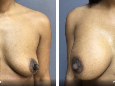 37-year-old female presented for breast augmentation. She desired more fullness in her breast. She underwent bilateral breast augmentation with 375cc Mentor HP implants. She is 5’5” tall and 160 lbs. B cup preop, D cup post op. She was very happy with her results.