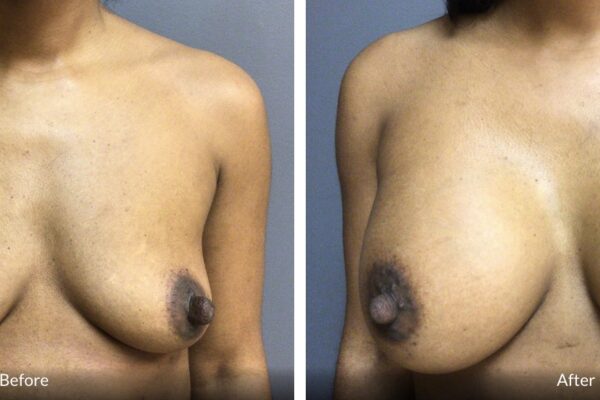 37-year-old female presented for breast augmentation. She desired more fullness in her breast. She underwent bilateral breast augmentation with 375cc Mentor HP implants. She is 5’5” tall and 160 lbs. B cup preop, D cup post op. She was very happy with her results.