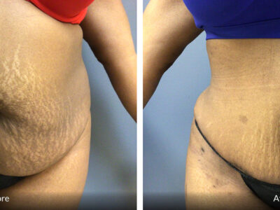 36 year old 5'4 before and 1 year after tummy tuck surgery