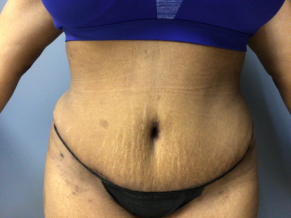 36 year old female 5'4" 1 front view after 1 year