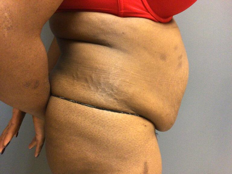 36 year old female 54 before right view