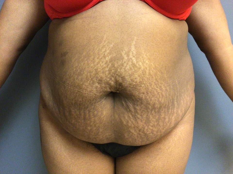 36 year old female 5'4" front view before