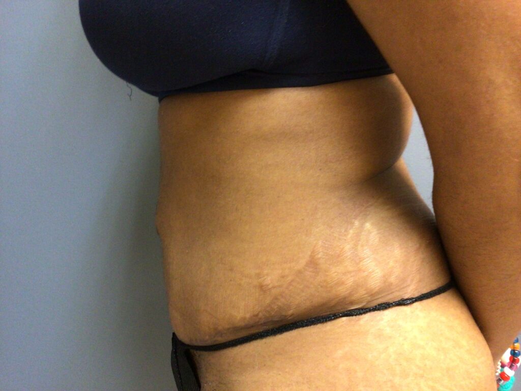 33 year old female 7 months post op abdominoplasty