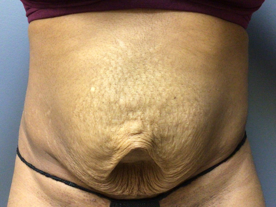 33 year old female 7 months post op abdominoplasty