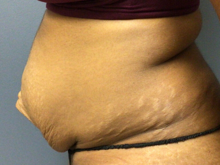 33 year old female 7 months post op abdominoplasty