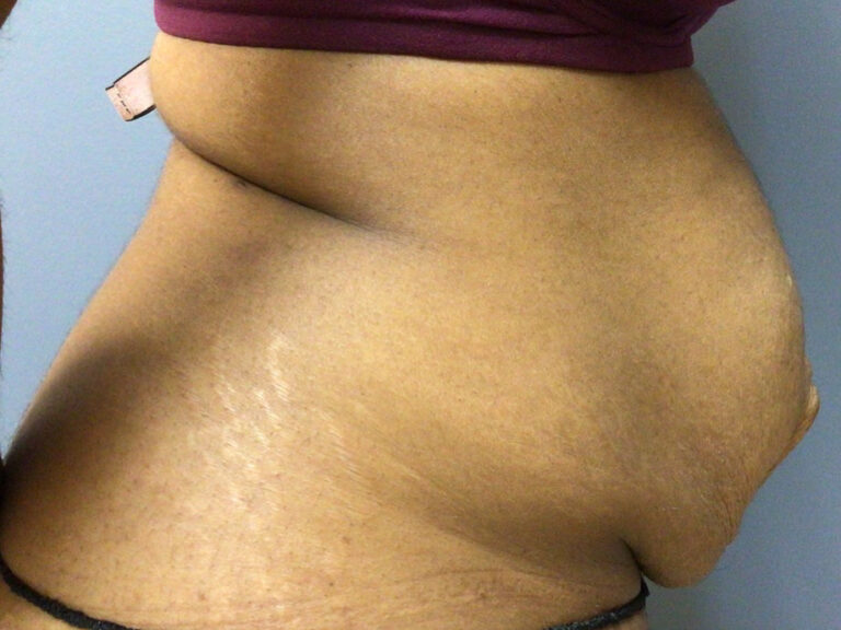 33 year old female 7 months post op abdominoplasty