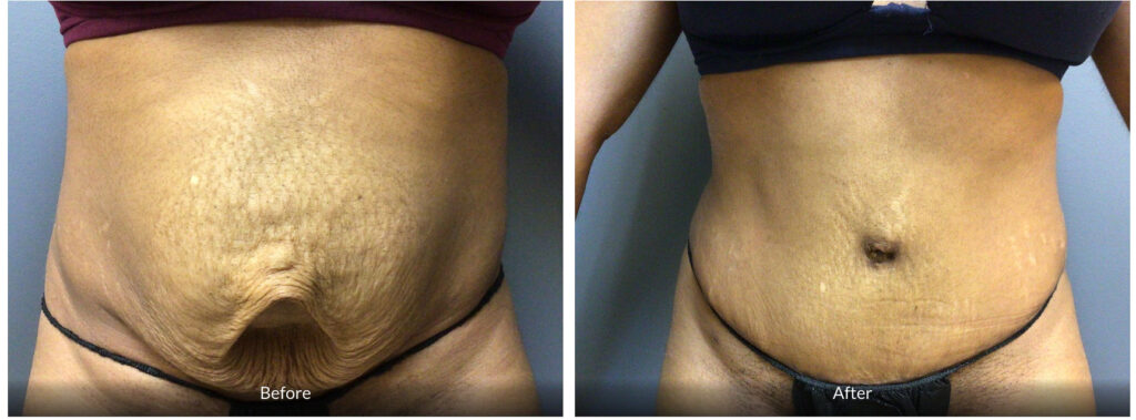 before and after 35 year old tummy tuck with umbilical hernia repair