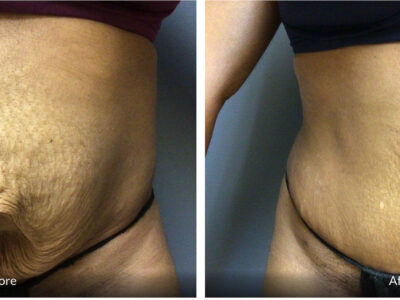 before and after 35 year old tummy tuck with umbilical hernia repair