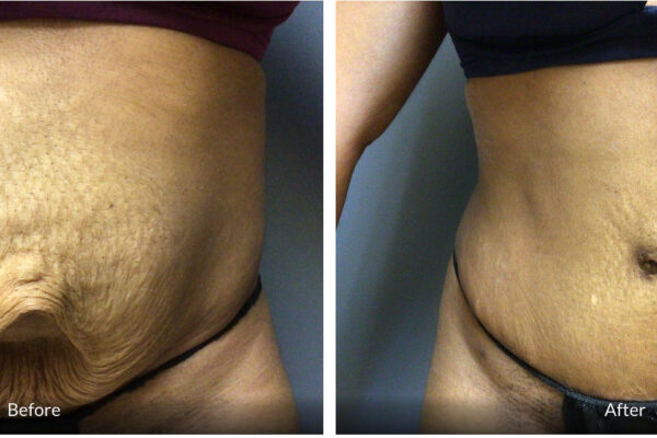 before and after 35 year old tummy tuck with umbilical hernia repair