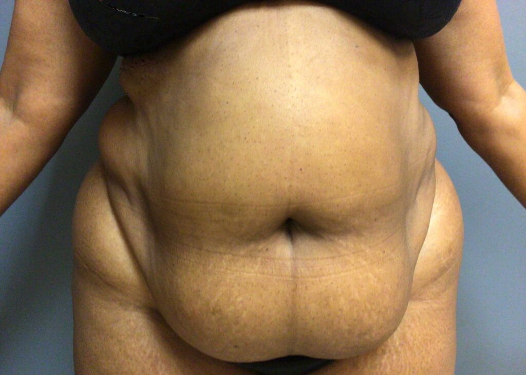 56 year old female before surgery