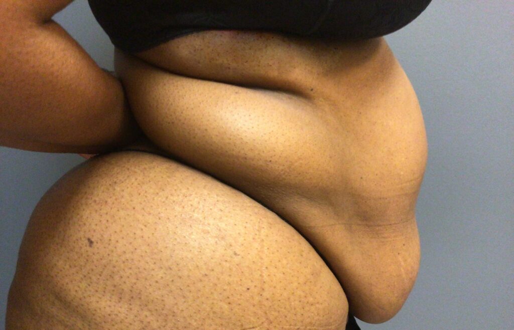 56 year old female before surgery side view